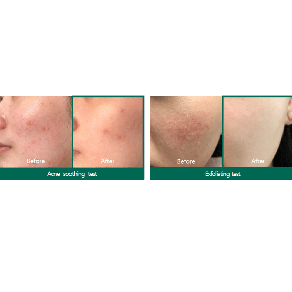 SOMEBYMI AHA - BHA - PHA Miracle Acne Clear Reinigungsschaum 100 ml - MAOMAO